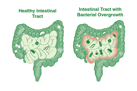 Intestinal Tract with Bacteria Overgrowth
