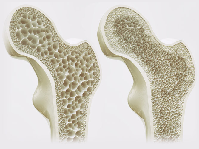 Increased Bone Density