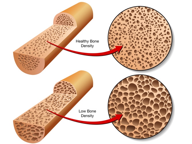 How Bone Density Declines with Age