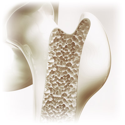 Osteoporotic Hip