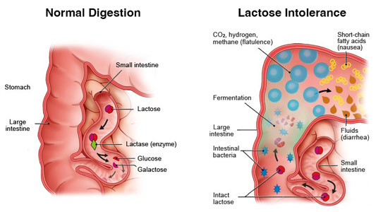 Intestinal Tract with Bacteria Overgrowth