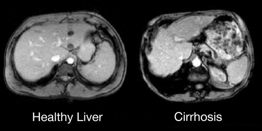 Difference Between Healthy Liver and Cirrhosis