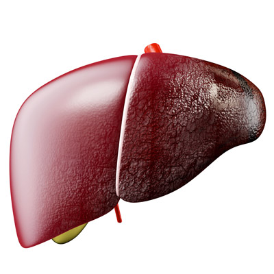 Progression of Fatty Liver Disease
