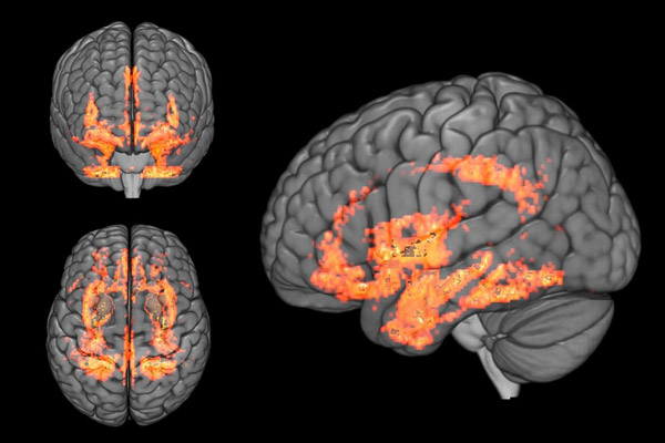 How Declining Estrogen Levels During Menopause Affect the Brain