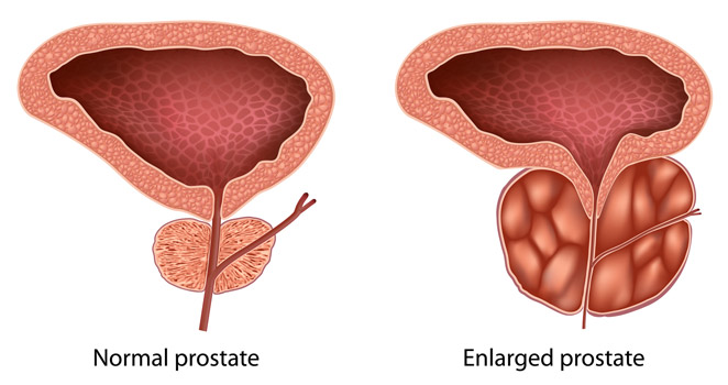 Difference Between Normal and Enlarged Prostate