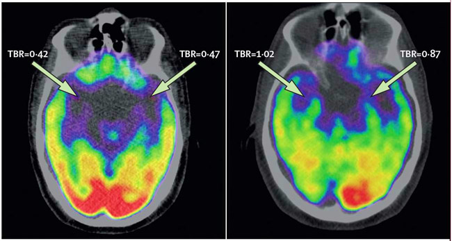 Brain Activity Calm vs. Stressed