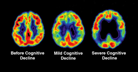 Effects of Cognitive Decline on Neural Activity