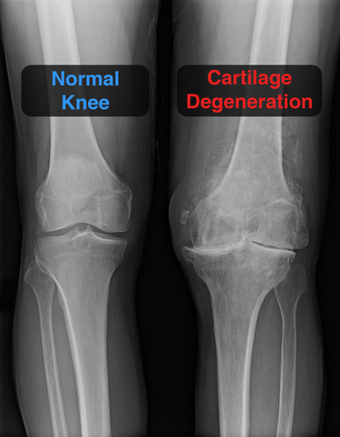 Effects of Cartilage Degeneration on an Inflamed Knee Joint
