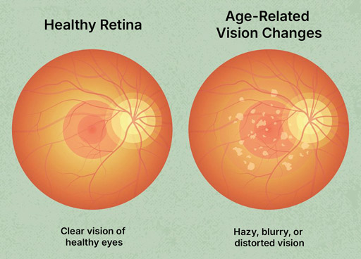 Age-Related Vision Changes